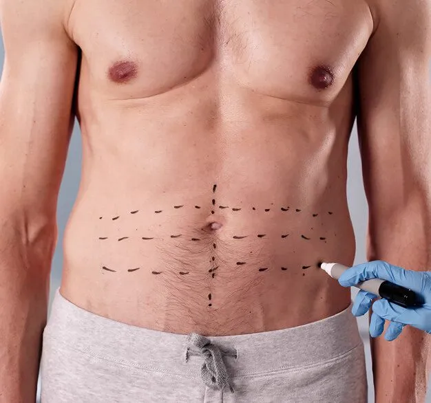 Why choose Tummy Tuck